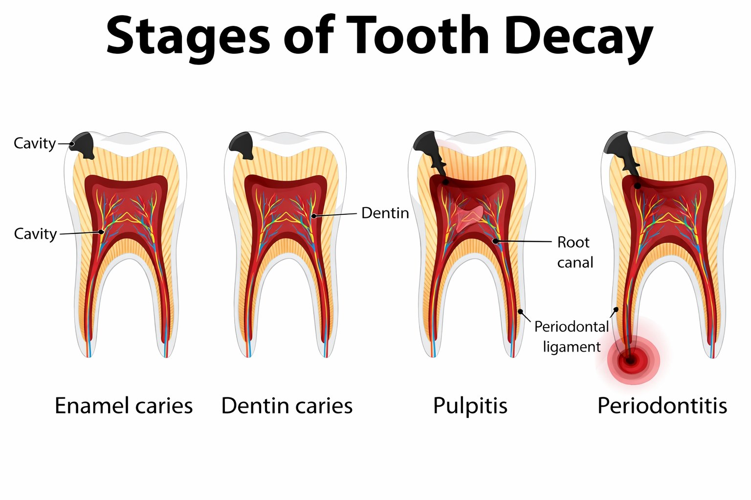 What Does a Cavity Look Like? Early vs Advanced Signs Explained